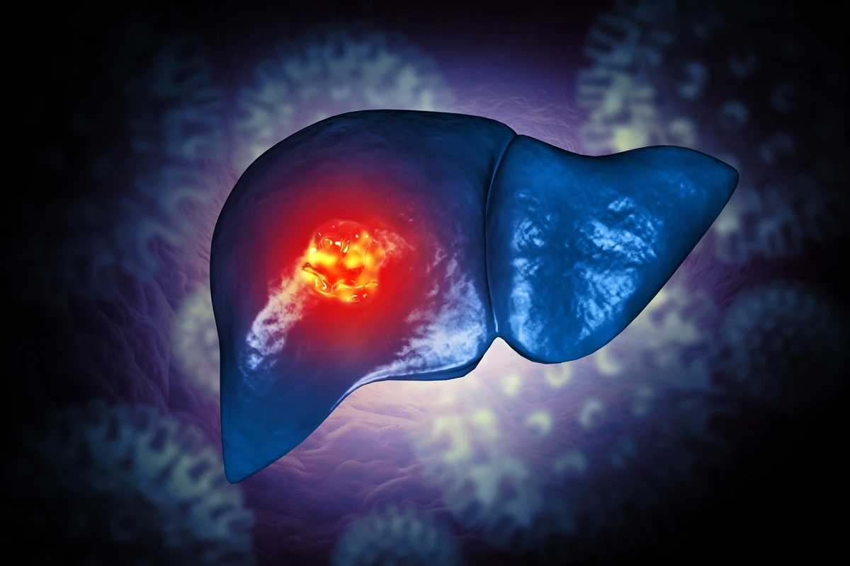 1 de 1 Ilustração de fígado com tumor de câncer - Estudo sugere que reduzir proteína pode de...