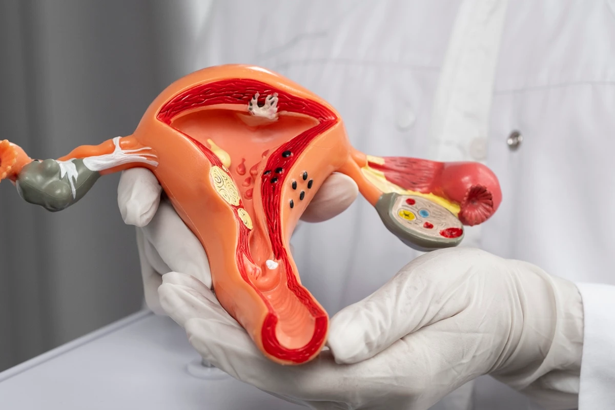 1 de 1 Foto colorida de médico segurando um modelo 3D do útero feminino - Câncer de colo do ú...