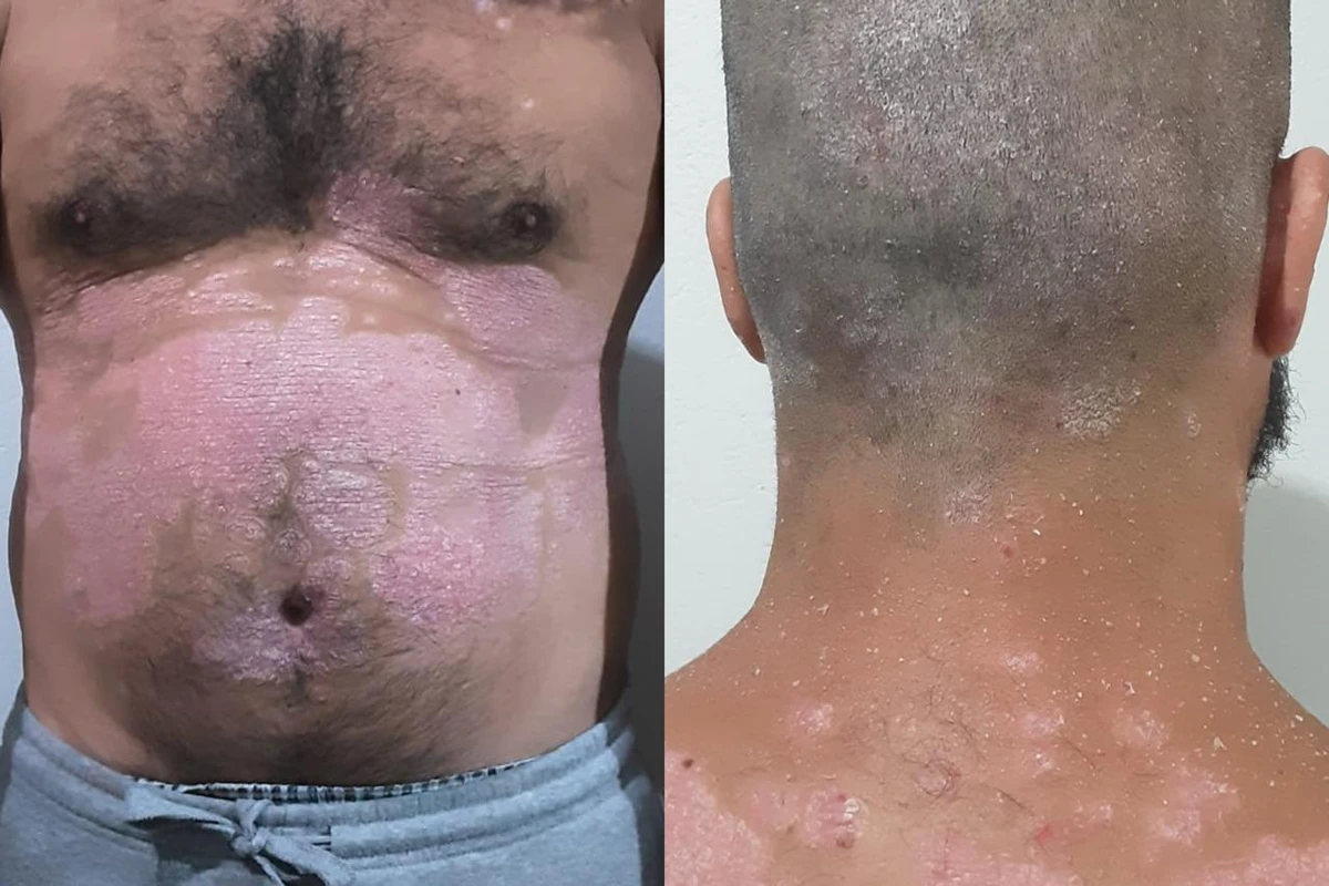 1 de 1 colagem de foto colorida de parte do corpo de um homem com psoríase - Metrópoles. - Foto...