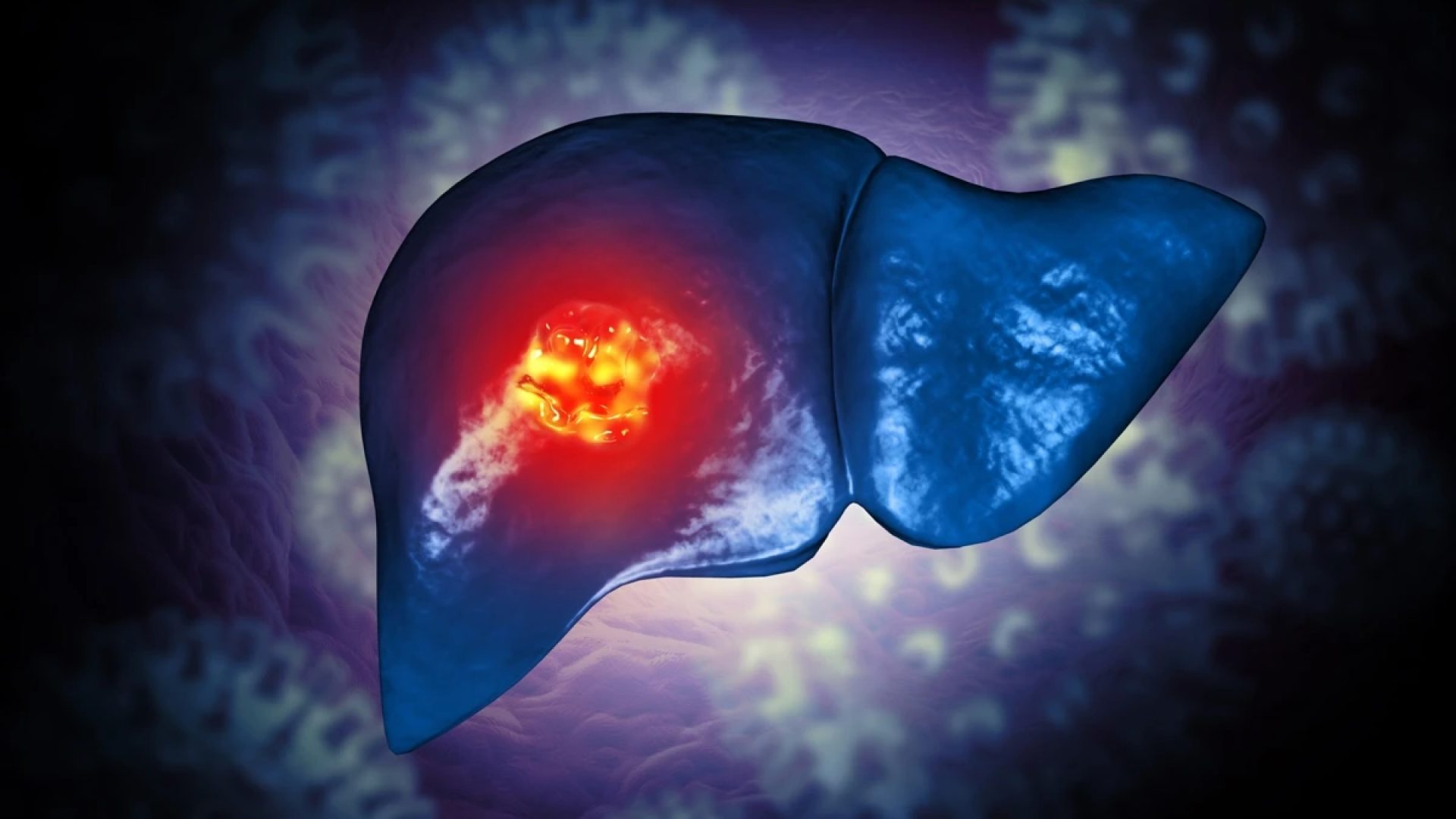 1 de 1 Ilustração de fígado com tumor de câncer - Estudo sugere que reduzir proteína pode de...
