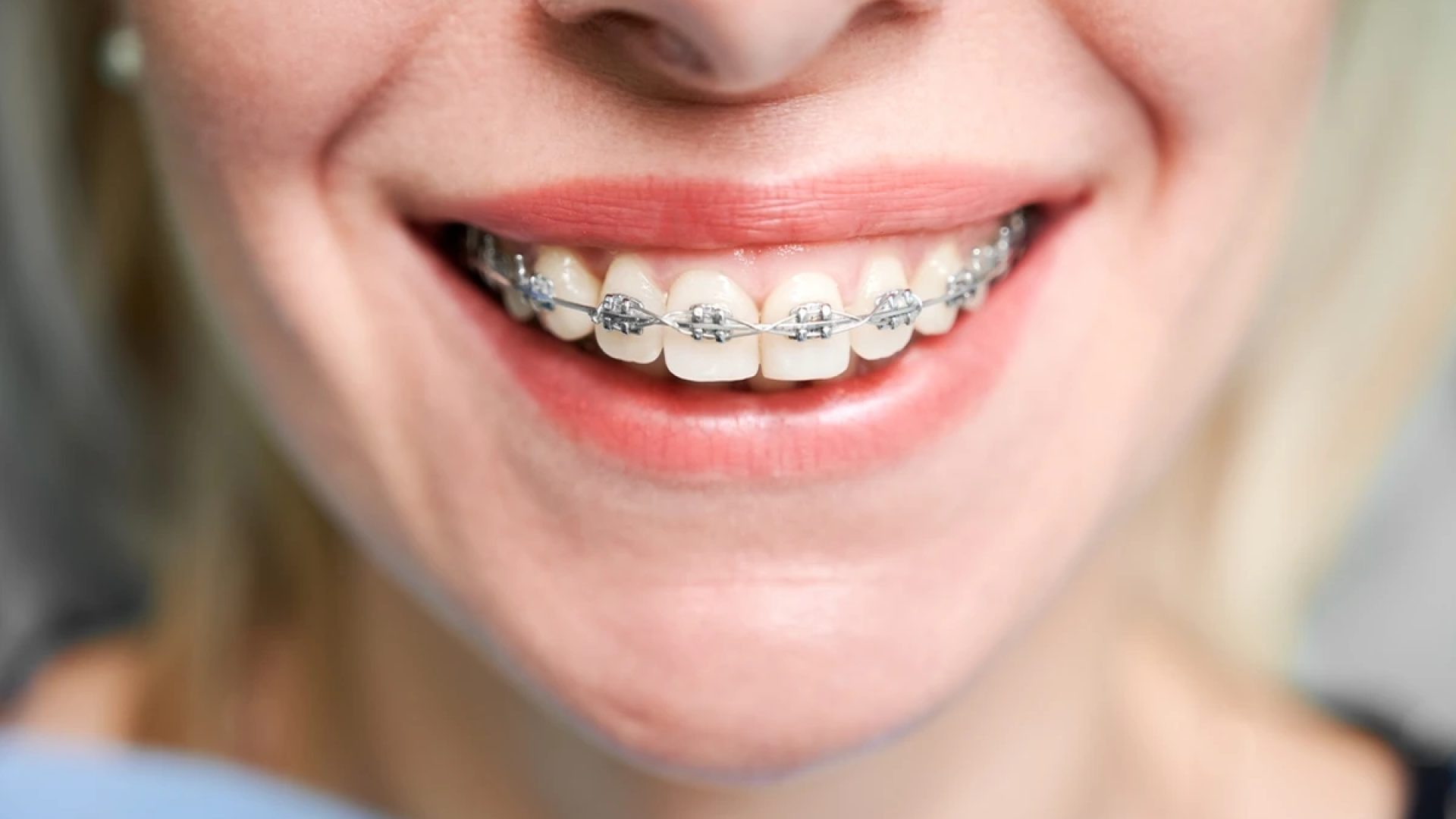 1 de 1 Mulher sorrindo com aparelho ortodôntico - Metrópoles - Foto: Freepik