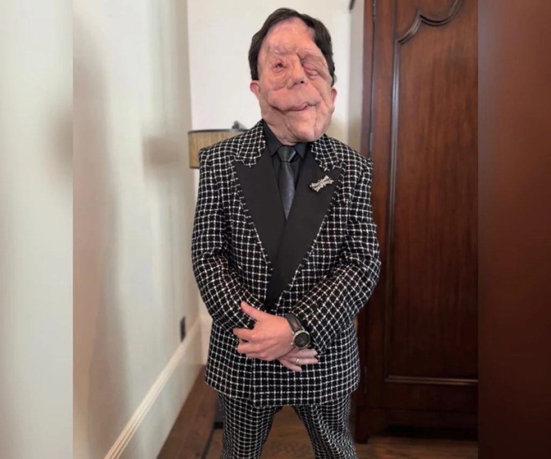 1 de 1 ator britânico Adam Pearson. Ele possui uma doença rara chamada neurofibromatose. Metró...