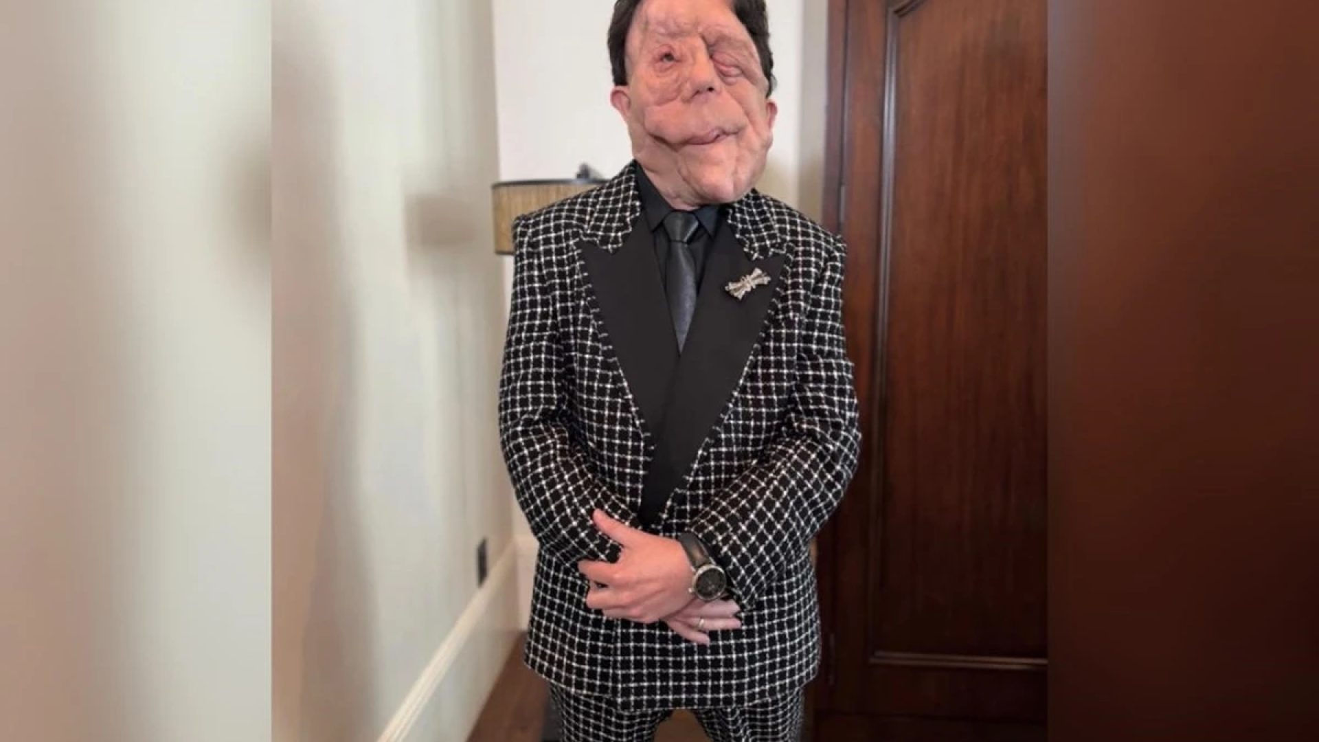 1 de 1 ator britânico Adam Pearson. Ele possui uma doença rara chamada neurofibromatose. Metró...