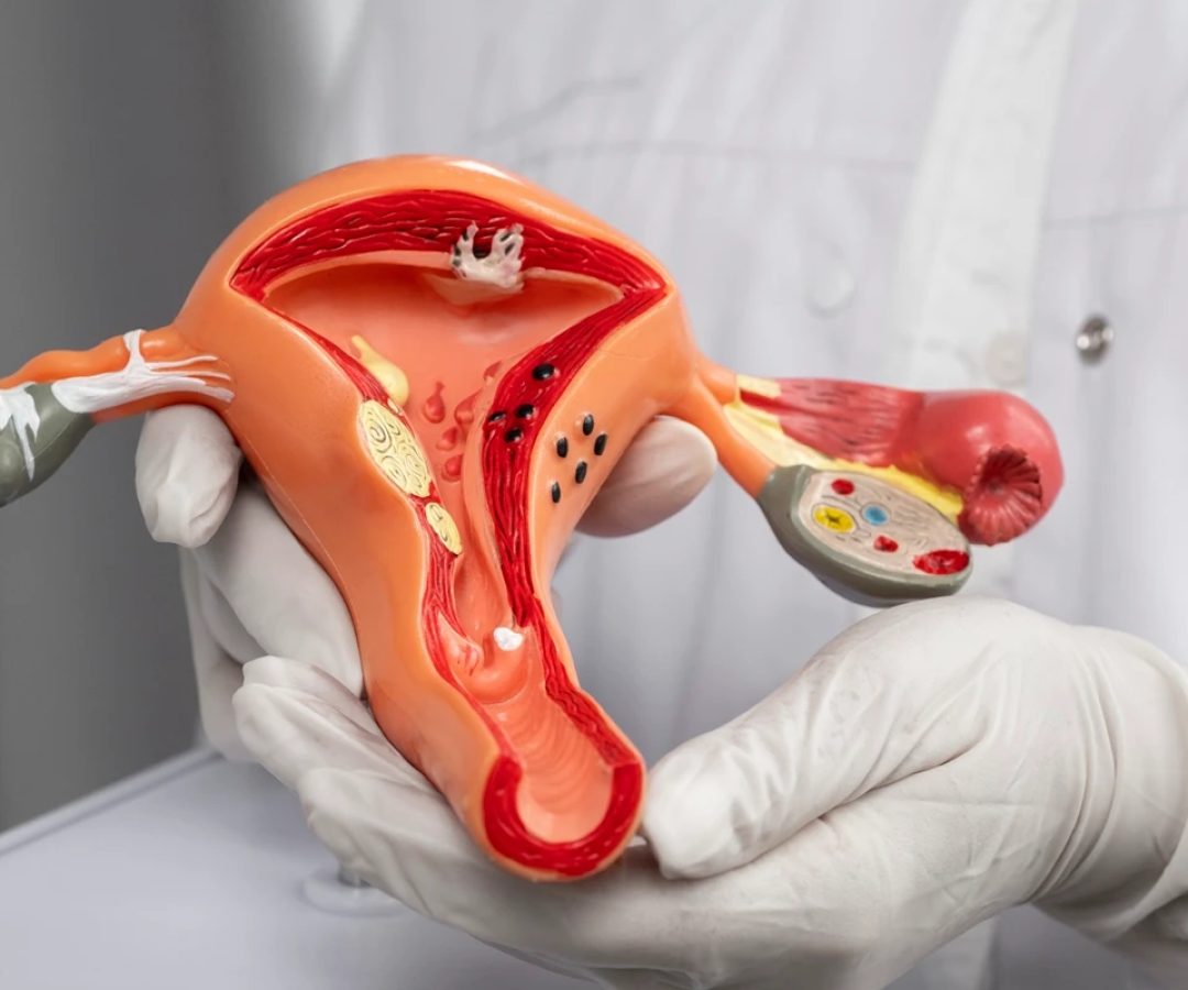 1 de 1 Foto colorida de médico segurando um modelo 3D do útero feminino - Câncer de colo do ú...