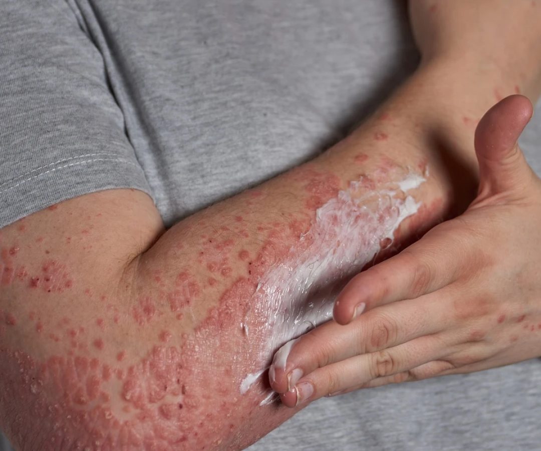 1 de 1 Foto colorida de braço humano com manchas vermelhas, dermatite - Metrópoles - Foto: Freepik