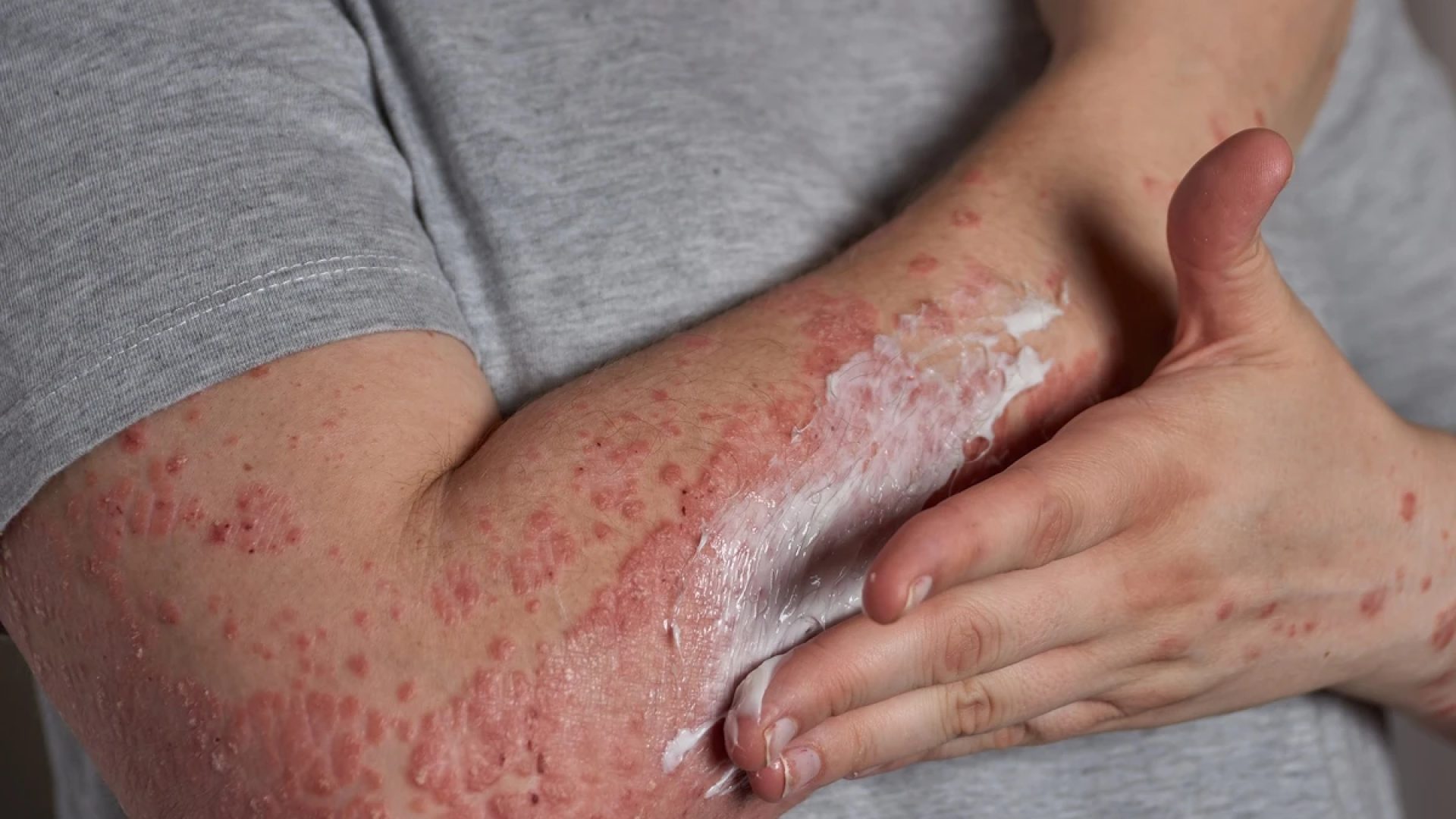 1 de 1 Foto colorida de braço humano com manchas vermelhas, dermatite - Metrópoles - Foto: Freepik