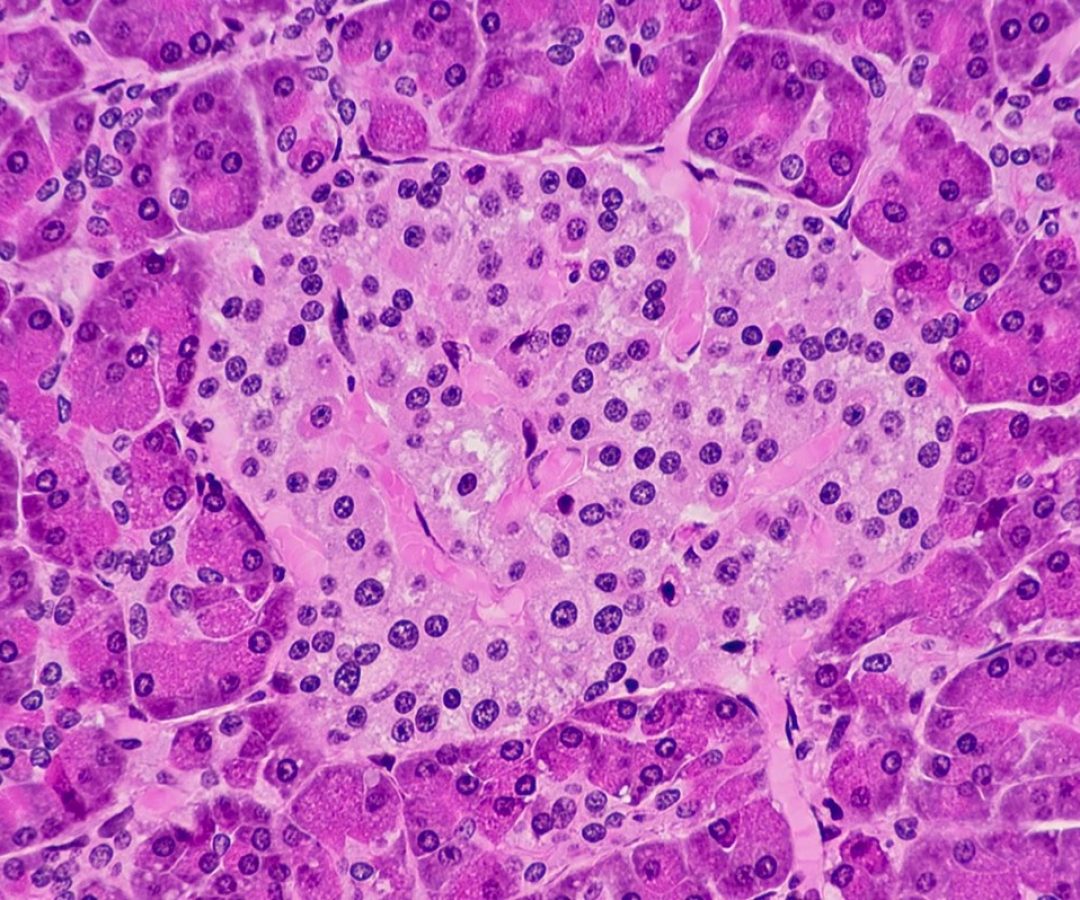 1 de 1 Imagem de microscópio tonalizada em rosa mostra área do fígado que secreta insulina - M...