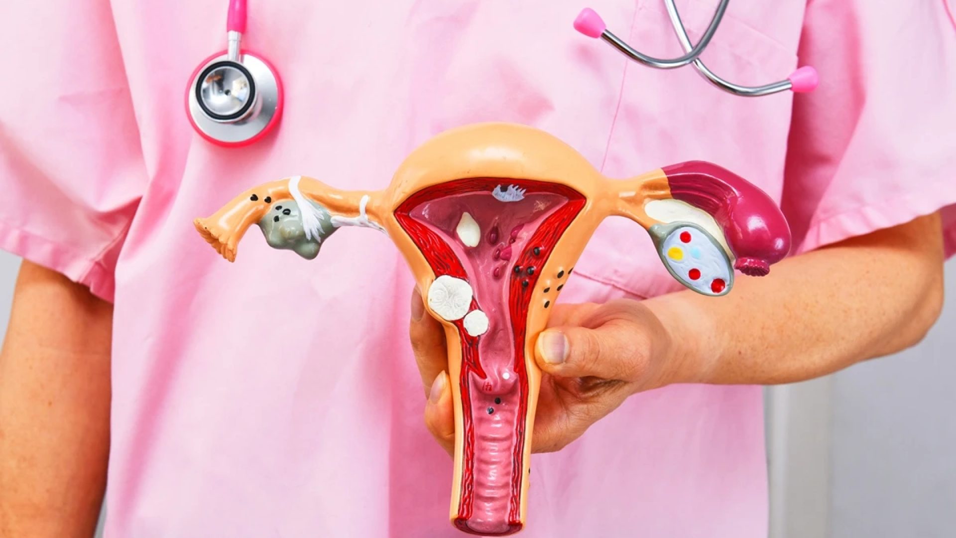 1 de 1 Cirurgião segurando modelo anatômico de patologias comuns. Conceito de câncer ou endome...