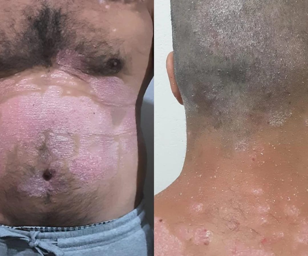 1 de 1 colagem de foto colorida de parte do corpo de um homem com psoríase - Metrópoles. - Foto...