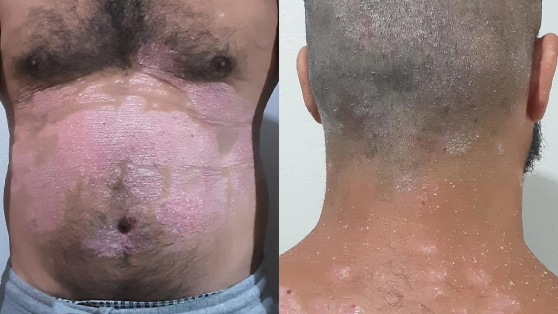 1 de 1 colagem de foto colorida de parte do corpo de um homem com psoríase - Metrópoles. - Foto...